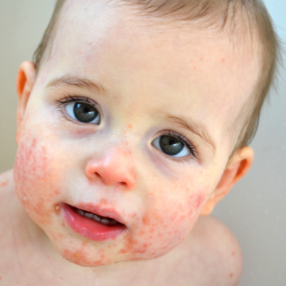 Lista Foto Tipos De Alergias En La Piel De Bebes Lleno